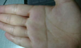 婴儿断掌图片,罕见遗传现象的医学解读