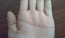 婴儿断掌图片,罕见遗传现象的医学解读